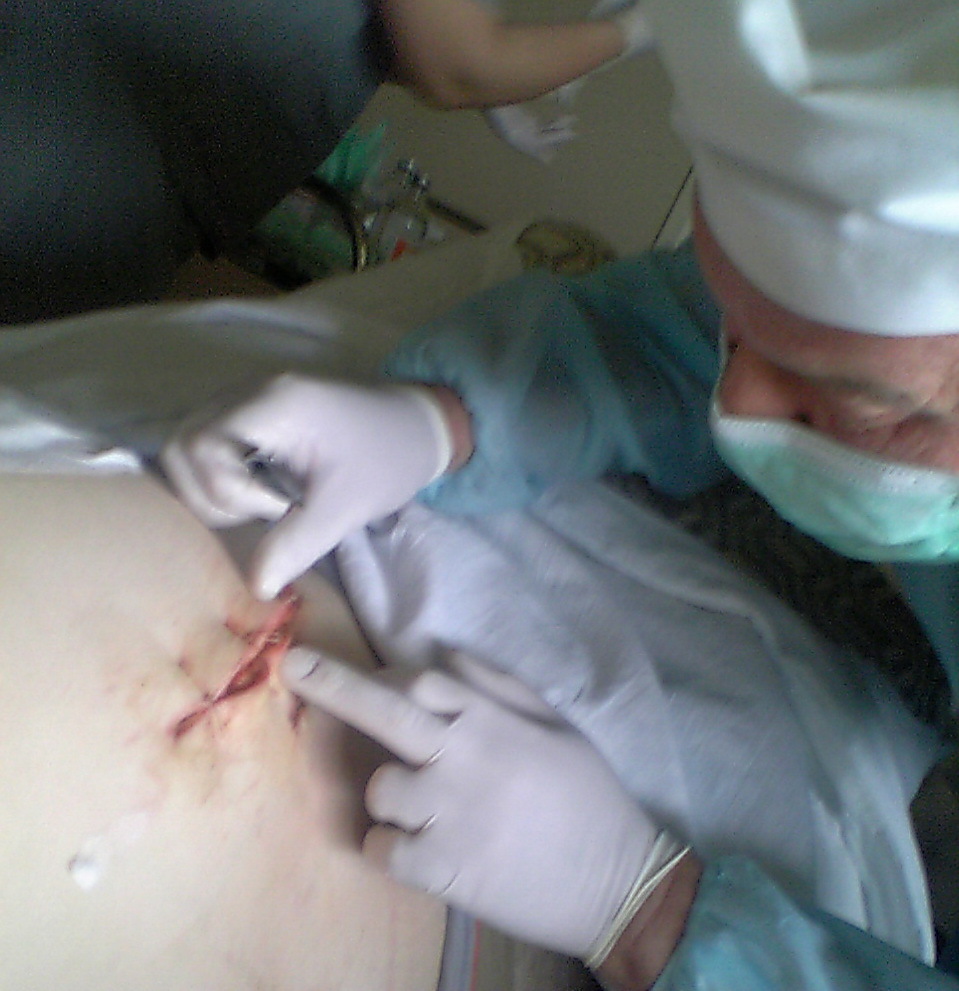 Обрезание члена (мой опыт в году) | Пикабу