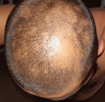 Как быстро растут волосы на голове у мужчин после стрижки налысо