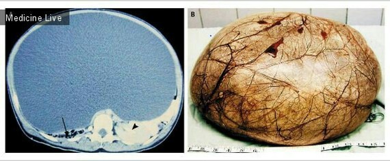 Giant ovarian cyst - The medicine, The photo, Cyst