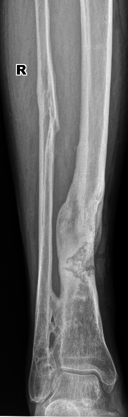 From the life of a radiologist. Part 16 - My, X-ray, The medicine, Fracture, Diverticulitis, Pneumothorax, Hydrothorax, Scoliosis, Longpost