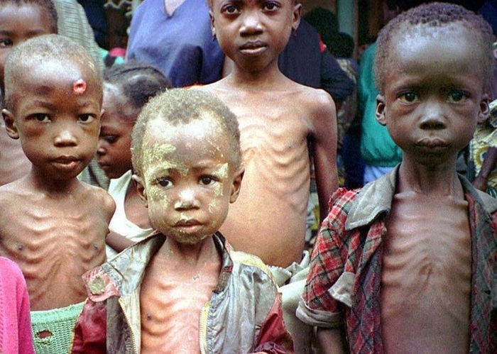 Yemeni Holodomor - Politics, UN, Yemen, Holodomor, Hunger, Catastrophe, Epidemic, Saudi Arabia