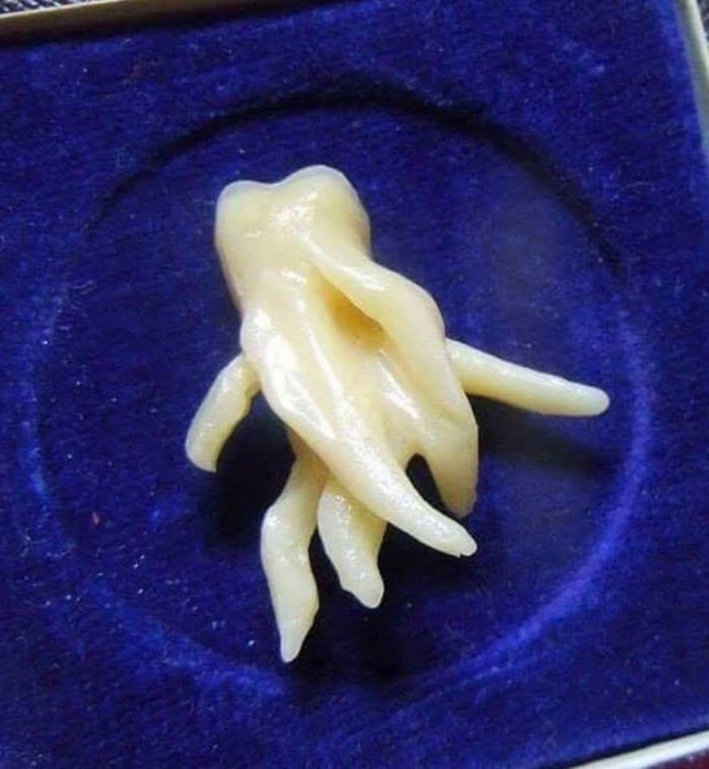 Unusual tooth - Unusual, Dentist, Teeth, Not mine