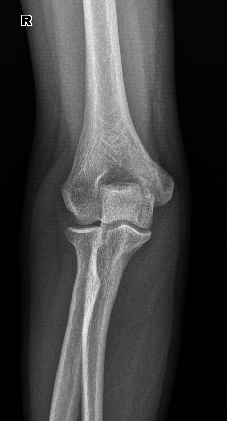 Снимок локтевого сустава в норме фото в норме