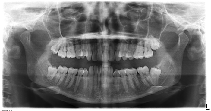 How disgusting is this eight? - My, Teeth, Eight, X-ray