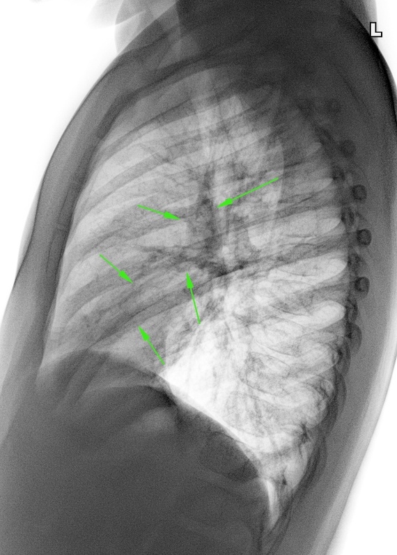 Diagnosis and treatment of benign lung tumors