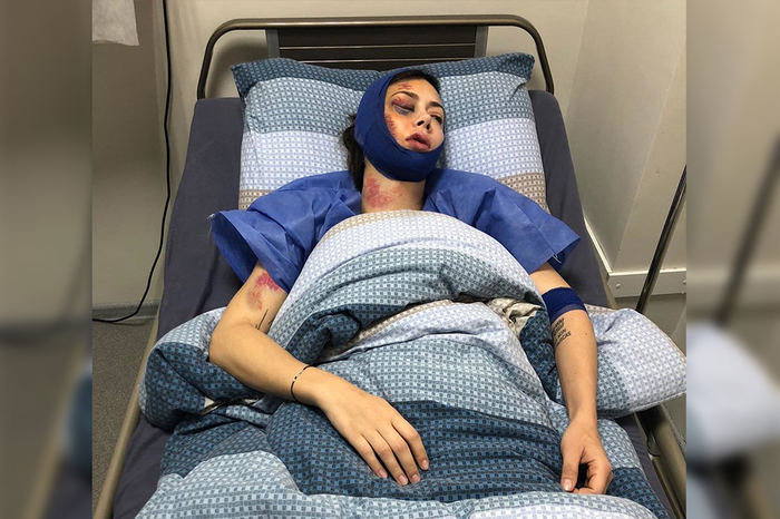 Revenge for Revizorro?: Samburskaya was severely beaten This is reported by the Rambler. - Revizorro, Samburskaya, news, Nastasya Samburskaya