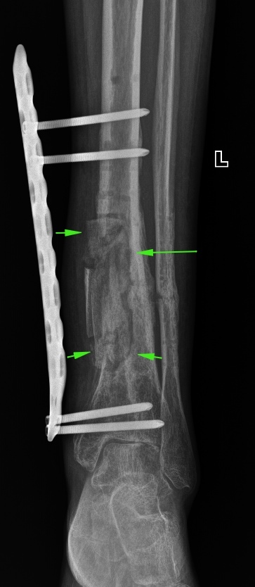 From the life of a radiologist. Part 22. Traumatic. - My, X-ray, The medicine, Longpost