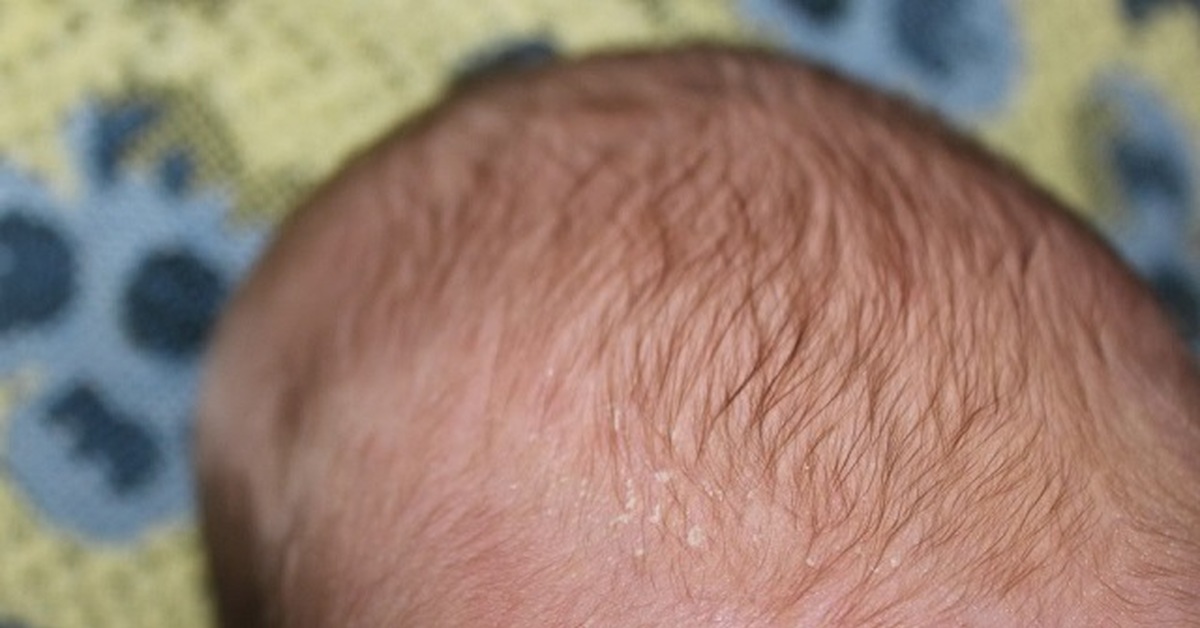 У младенца шершавая кожа на голове thumbnail