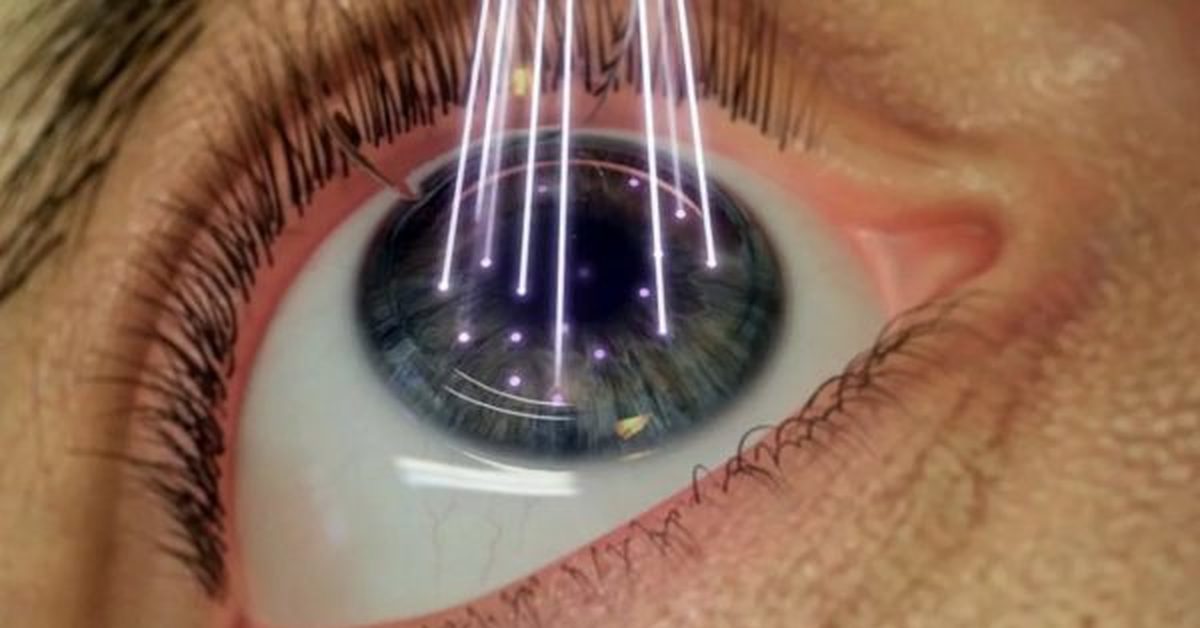 Операция на глаза восстановление зрения. ФРК ласик. Лазерная рефракционная кератопластика.