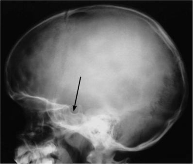 About how I was diagnosed with a tumor. - Story, Health, The medicine, X-ray, Military enlistment office, Hospital, Doctors, Longpost