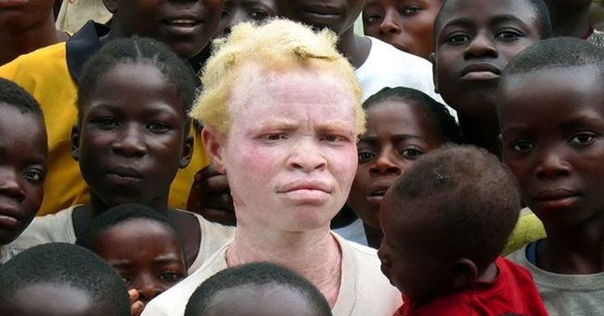Мечтала о негре. Альбинос негроидной расы. Афроамериканец альбинос.