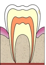 После лечения зуба остались пятна thumbnail