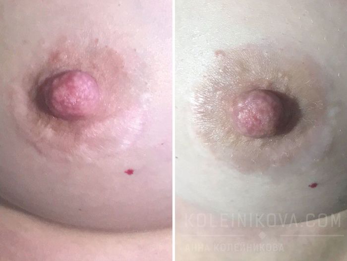 Tattoo of the nipple areolar complex. Micropigmentation of the areola of the breast. - NSFW, My, Mammoplasty, Breast, Nipples, Areola, Scar, Disguise, Tattoo