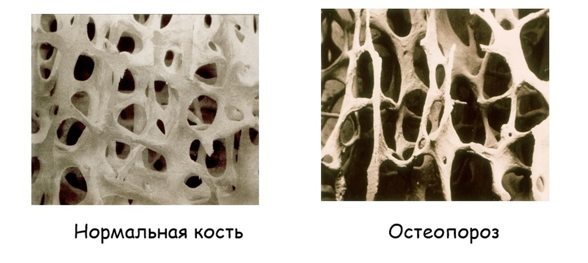 Изменение структуры кости. Нормальная кость и остеопороз. Костная ткань остеопороз. Костный ткань нормальная и остеопороз. Структура костной ткани остеопороз.