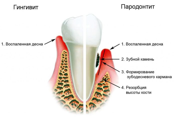 №2 Professional oral hygiene. - My, Dentistry, , Longpost, , Dentist, Hygiene