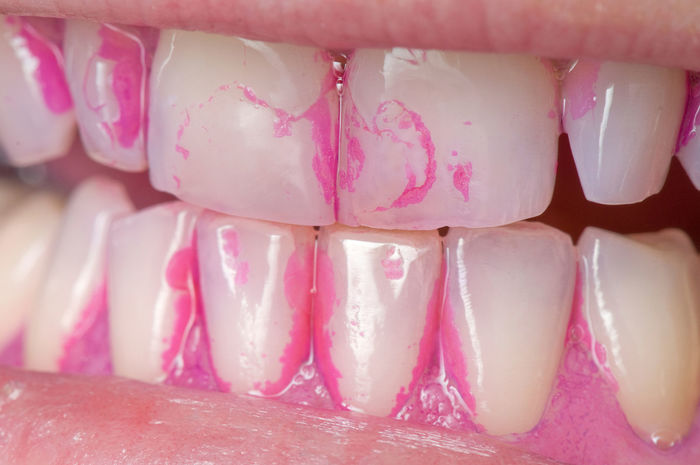 Гигиену полости рта делают до лечение зубов thumbnail