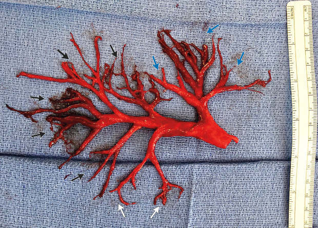 The patient coughed up a bloody cast of the bronchial tree - The science, news, The medicine, Blood, Bronchi, Horror