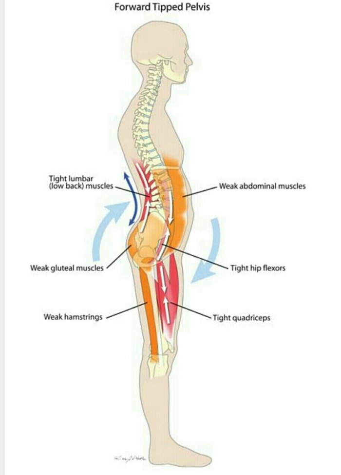 About the balance of the pelvis and a sore back - Longpost, The medicine, Sport, PHYSICAL THERAPY, Rehabilitation, Spine, Health, Pain, Back, My