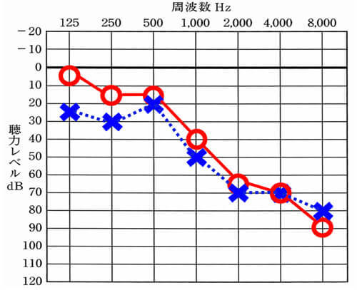 About hearing and fitting hearing aids - Hard of hearing, My, Health, Longpost