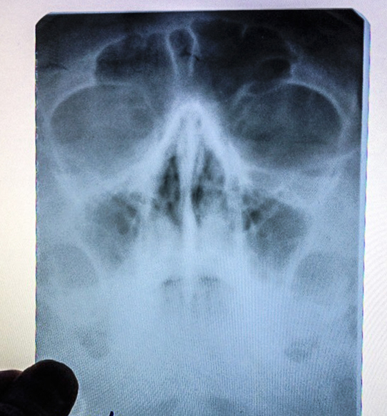 Burned or Post about instant and painless healing - My, Longpost, X-ray, Russia, Nose, ENT-Doctors