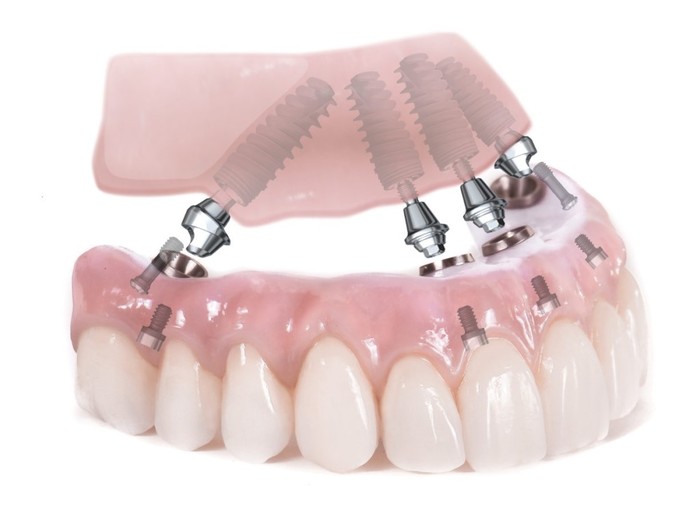 She put it on the shelves: why is implantation so expensive? - Dentistry, Useful, Prosthetics, Longpost