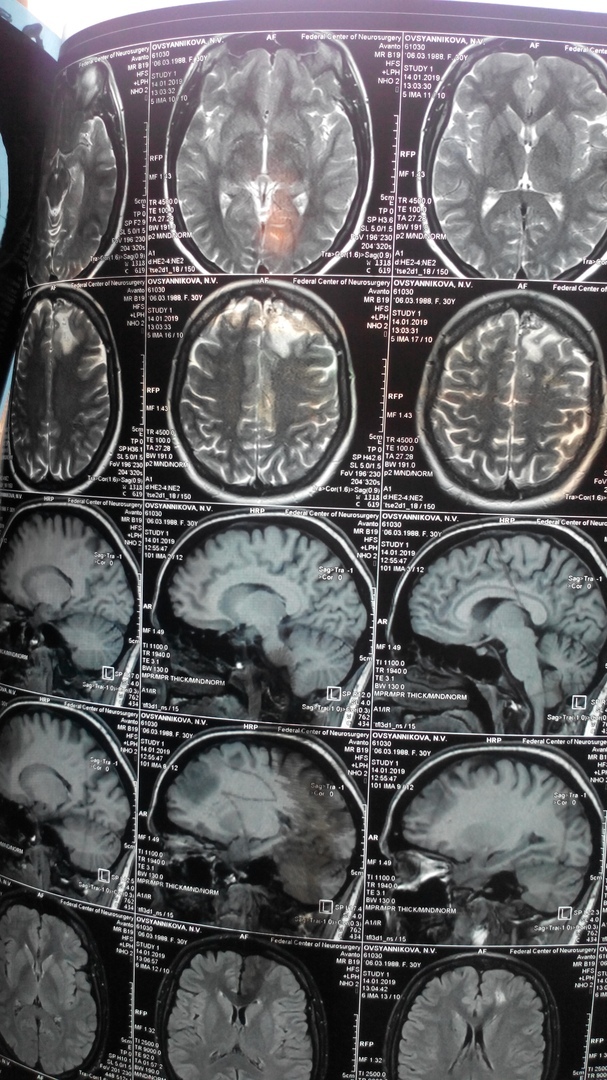 Left frontal lobe AVM - My, 16+, , , Embolization, Tyumen, Longpost, Arteriovenous malformation