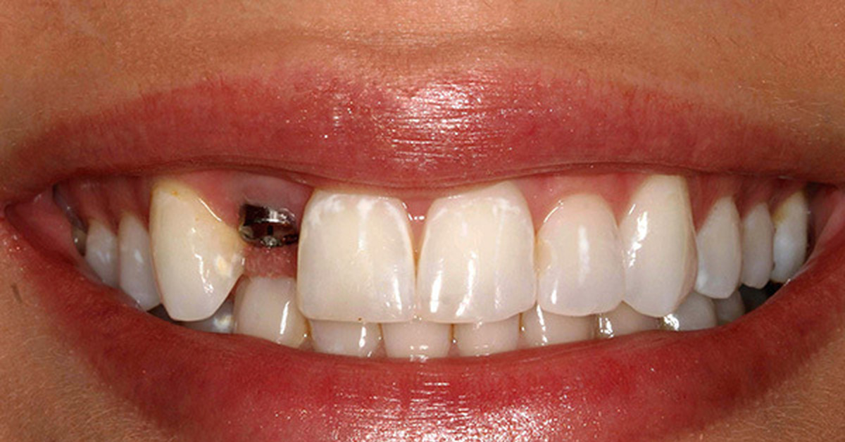 Как проходит имплантация зубов?