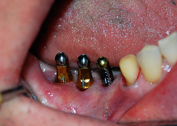 Как Выглядят Импланты Зубов Фото
