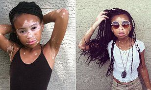 Vitiligo - Skin disease, , Longpost, Dermatology