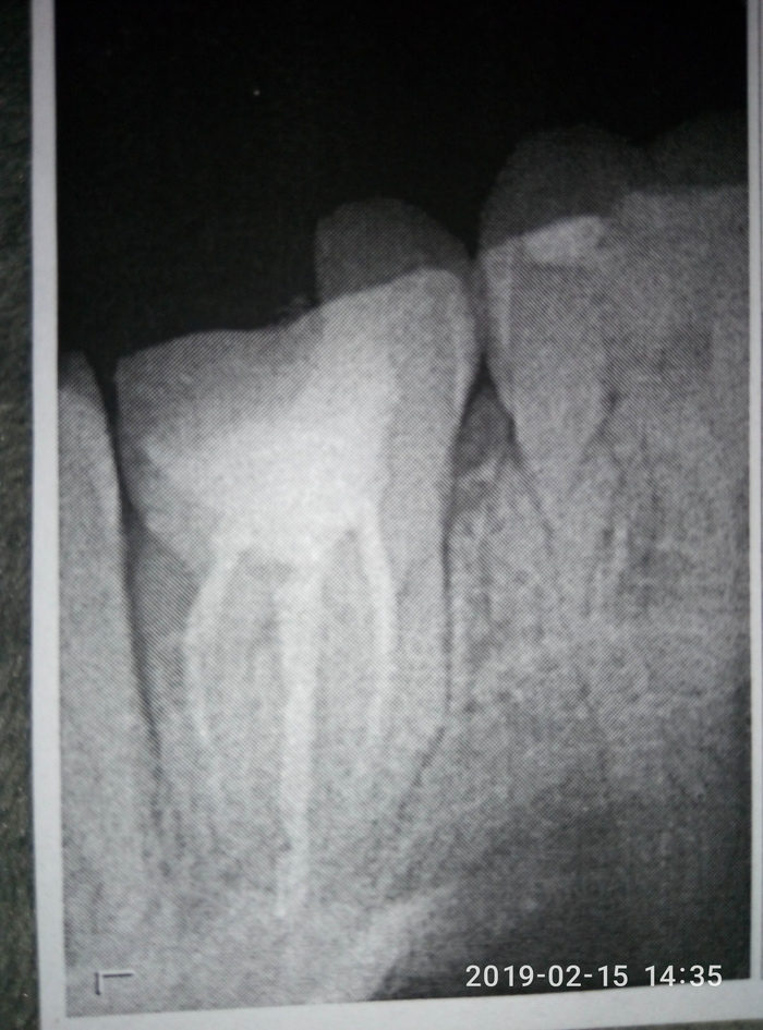 Пломба, пломба v2