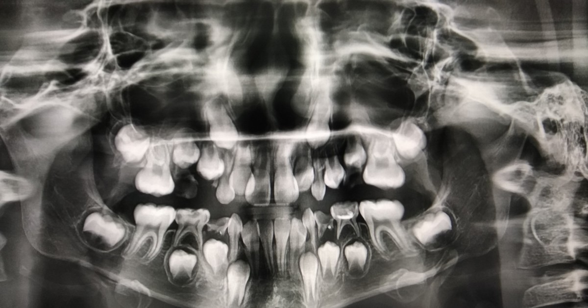 Рентген снимки детей. Ортопантомограмма (ОПТГ) молочные зубы. Рентген снимок сменного прикуса. Ортопантомограмма сменного прикуса.