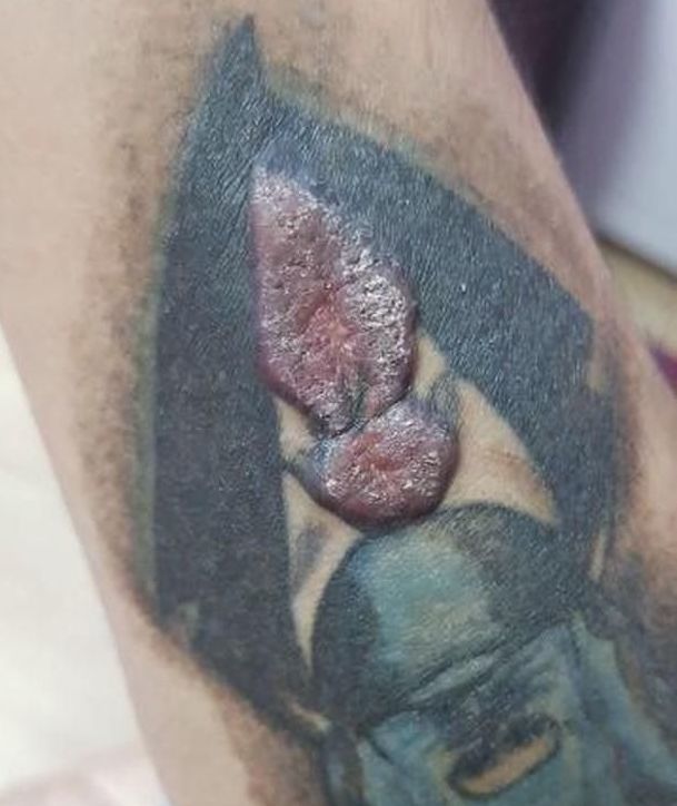 Обнаружена вероятная причина аллергии на татуировки