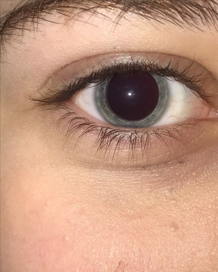 Effects of heroin on pupils - , Eyes, Longpost