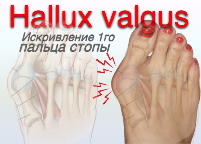 Hallux Valgus.   1  