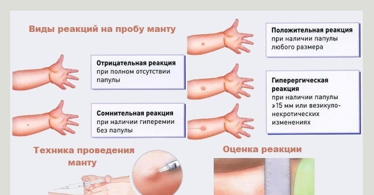 Манту до какого возраста делается детям. Реакция манту показатели нормы. Реакция пробы на манту норма ребенка. Нормальные показатели реакции манту. Реакция манту норма у детей 10 лет.