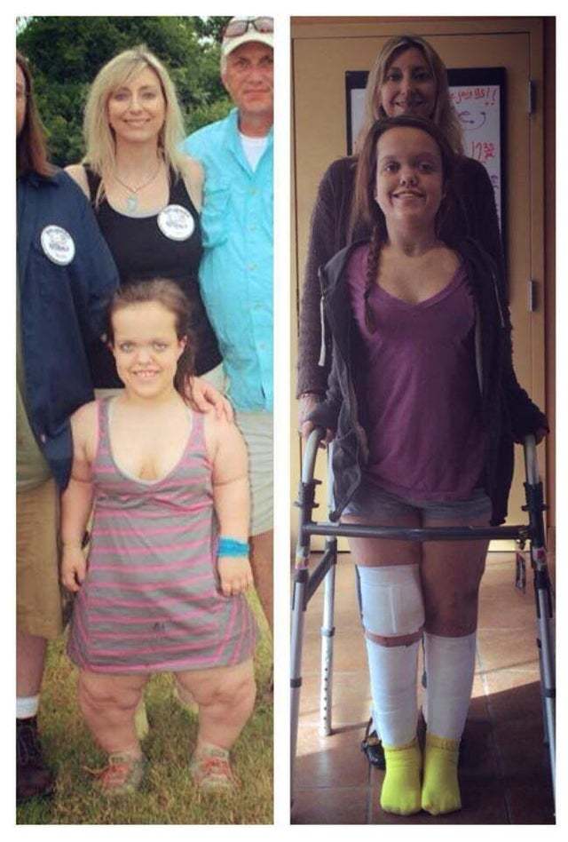Before and after limb lengthening - Reddit, Operation, Positive, It Was-It Was