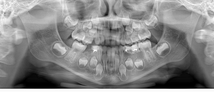 Teeth and how they grow. - My, Baby teeth, Radiology, , Teeth, Dentistry