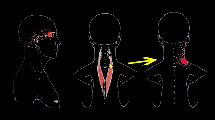 Как снять напряжение с мышц шеи при головной боли thumbnail