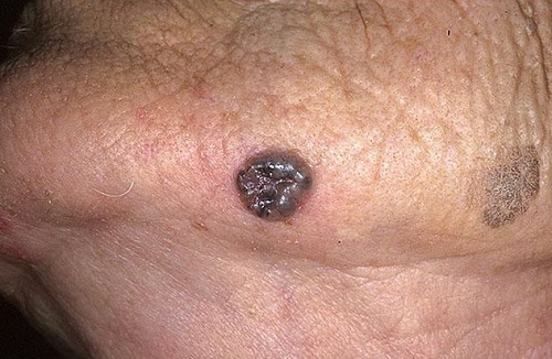 Как я вылечил рак кожи thumbnail