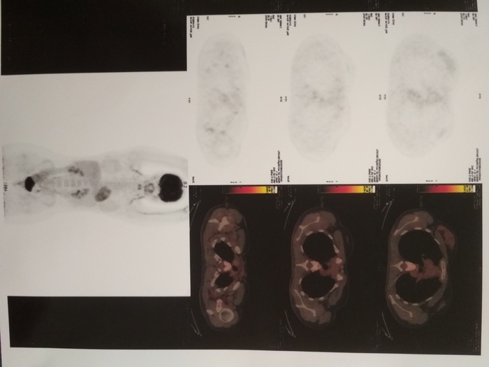 Hodgkin's Lymphoma or Turkish Vacation - My, Lymphoma, Hodgkin's lymphoma, Crayfish, Oncology