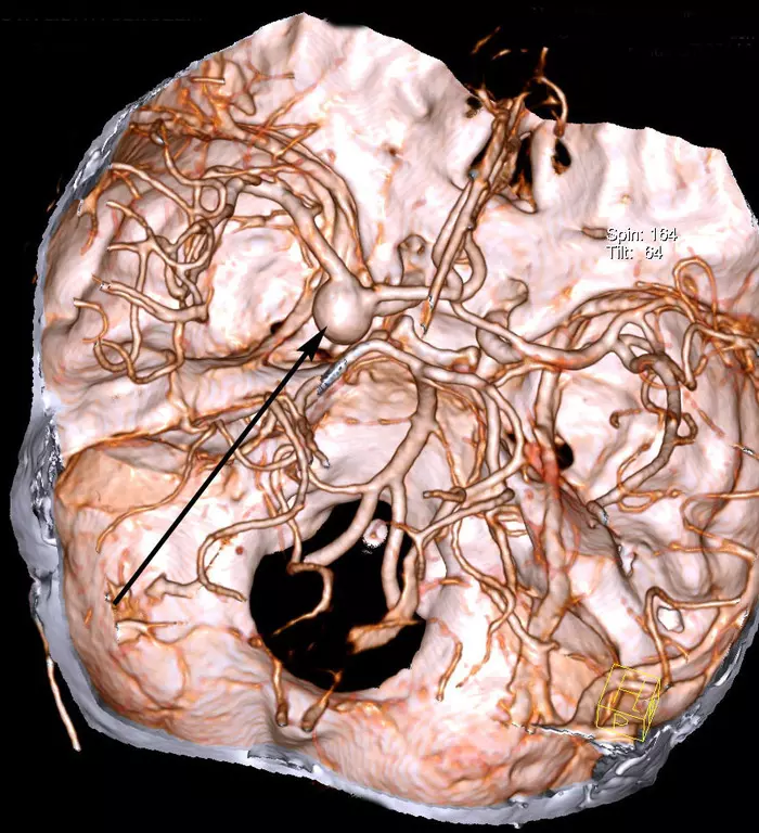 Немного про церебральные аневризмы - Моё, Медицина, Аневризма, Длиннопост, Нейрохирургия