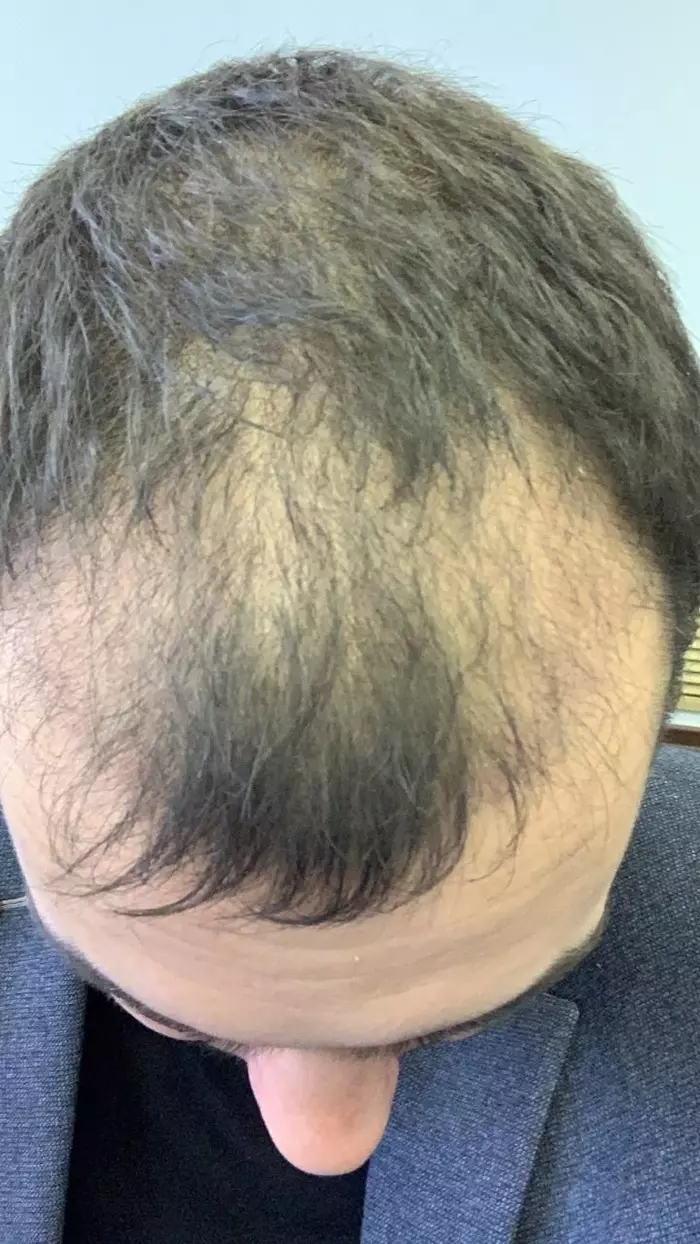 FUE hair transplant in Turkey!!! - My, Hair Transplant, Baldness, Longpost