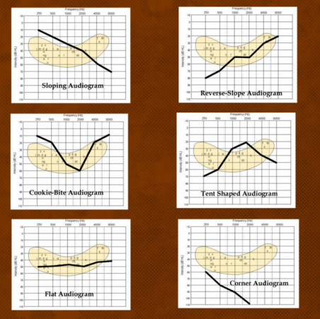 Features of hearing aid with U-audiogram - My, Hearing, Hearing aid, Hearing loss, , Health, Audiology, Longpost, Deafness