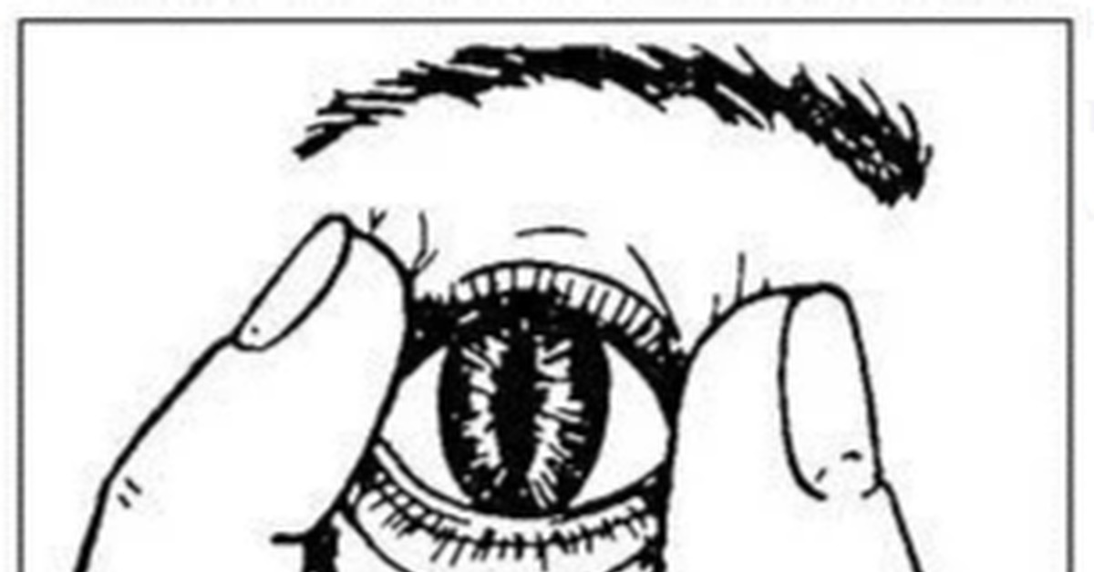 Синдром кошачьего глаза биологическая смерть. Симптом белоглазова (симптом «кошачьего зрачка»). Симптом кошачьего зрачка. Симптом кошачьего глаза признак. Признак белоглазова феномен кошачьего.