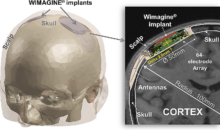 The future is coming - The medicine, Surgery, Neurosurgery, Future, Video, Longpost