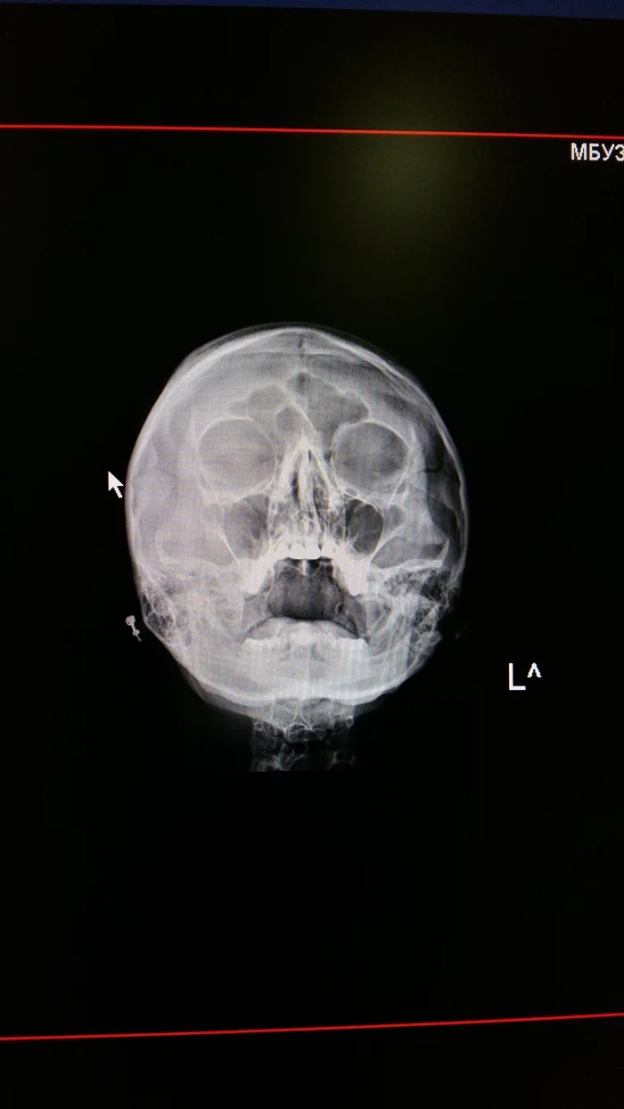 Sinusitis and antibiotic - Sinusitis, Anti-boitics, Longpost