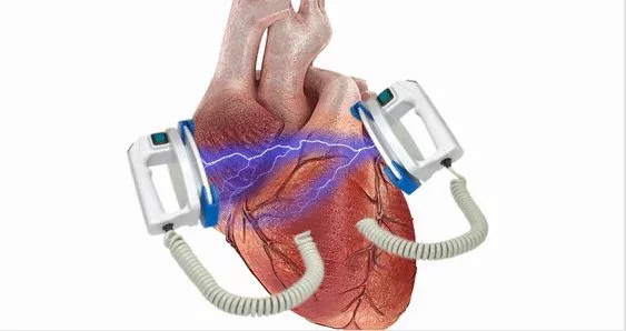 Can an electric shock restart a stopped heart? - My, Resuscitation, Defibrillator, The medicine