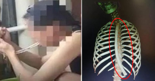 Wanting to lose weight, a woman accidentally swallowed a “vomit tube” - Freaks, Curiosity, Slimming, , China, Medical records
