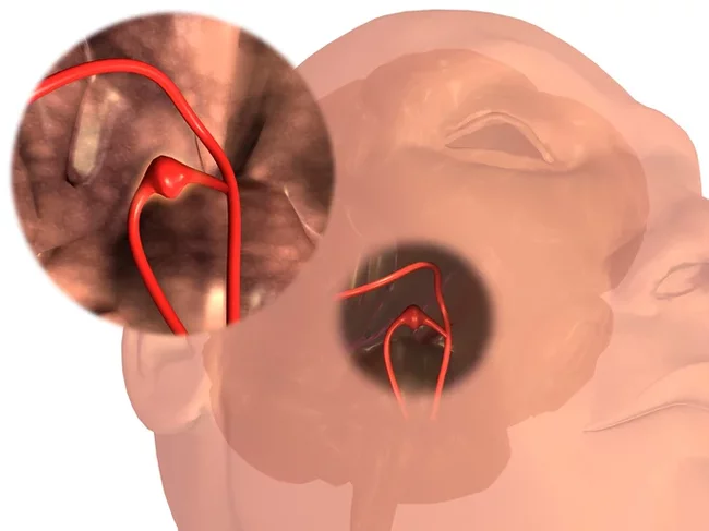 Rupture of a cerebral aneurysm - are there any chances? - My, Aneurysm, Resuscitation, Longpost