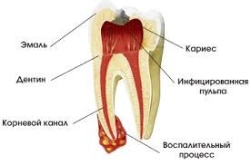 Стоматология - Моё, Стоматология, Пульпит, Кариес, Периодонтит, Флюс, Киста, Пародонтит, Пародонтоз, Длиннопост